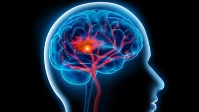أعراض تسبق الجلطة الدماغية بأسبوع.. انتبه لها