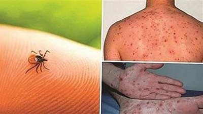 العراق: ارتفاع حصيلة الإصابات بالحمى النزفية إلى 303 حالات