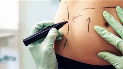 تكميم المعدة ليست عملية تجميل ونسب الوفاة منها ضئيلة