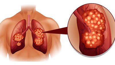 التدخين وأمراض الجهاز التنفسي السفلي.. دراسة تكشف العلاقة