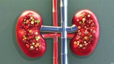 فيتامين يسبب حصوات الكلى