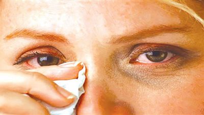 علاج مضاعفات حساسية العين