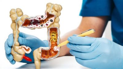 الصحة تؤكد توفير أدوية التهاب القولون التقرحى على نفقة الدولة