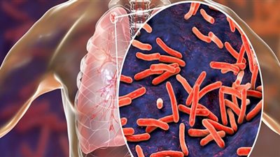 مرض السل يدق ناقوس الخطر في العالم .. أعراضه وطرق الوقاية