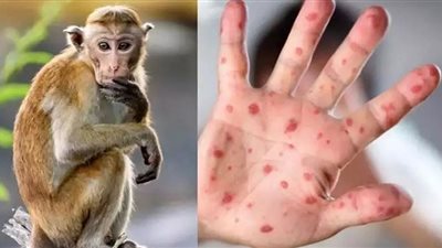 خبراء الصحة يكشفون كارثة جديدة عن جدري القرود