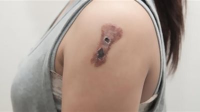 منها الشامة.. أبرز أعراض سرطان الجلد