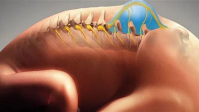 الصلب المشقوق.. معلومات صادمة حول أصعب داء يصيب الأطفال