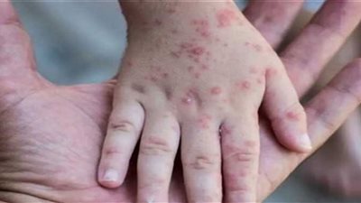 تطورات معدل الإصابة والوفاة بجدري القرود