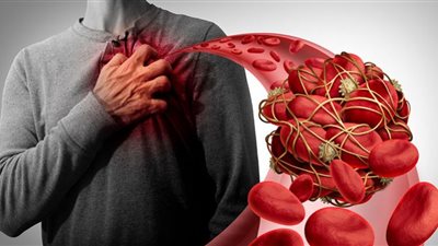 أعراض انسداد الشرايين بسبب الكوليسترول