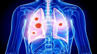 اكتشاف طبي يقلل وفيات سرطان الرئة