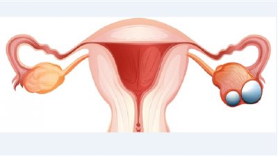 البصل يحمي من أمراض المبيض السرطانية