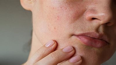 قواعد للتخلص من جفاف البشرة في الشتاء