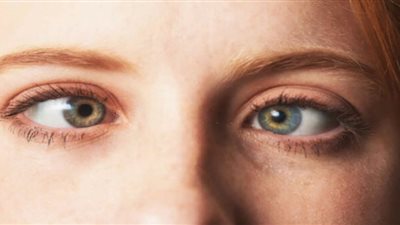 طبيب يكشف الأسباب الرئيسية لحول العين
