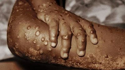 عزل مصاب بجدري القرود في مصر