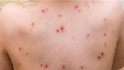 غسل الملابس وطهي اللحوم للوقاية من جدري القرود