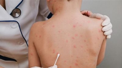 بعد ظهور أول حالة في مصر.. 5 إجراءات تحميك من الإصابة بـ