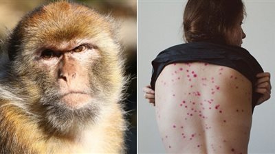 أعراض تؤكد إصابتك بـ