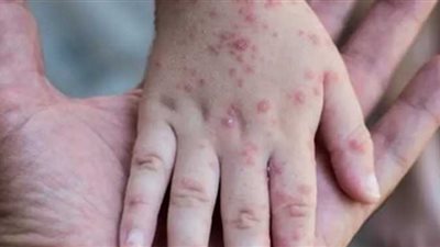 إحصائيات إصابات ووفيات جدرى القرود على مستوى العالم