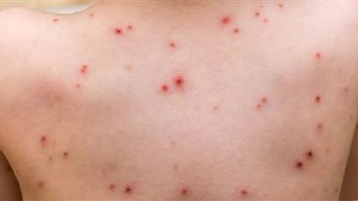 العلاقات غيرالعفيفة تزيد فرص الإصابة بجدرى القرود