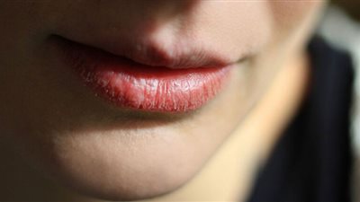 أسباب تشقق الشفاه