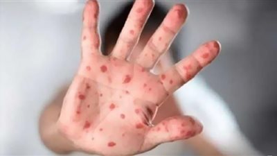 أعراض فيروس جدري القرود