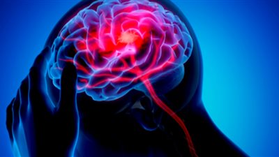 الصداع المستمر دليل على إصابتك بالسكتة الدماغية