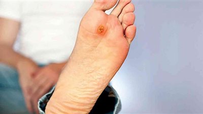 في يومه العالمي.. علامة تحذيرية من قرح القدم السكرية