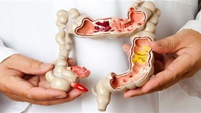 نوع من الخضراوات ممنوع على مرضى التهاب الرتج المعوي