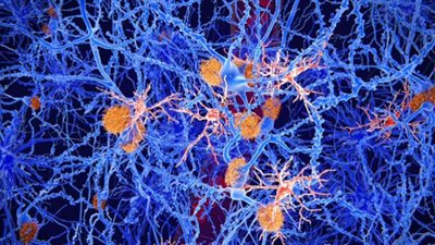 عقار ألزهايمر المنتظر يفشل في تحقيق هدفه في علاج المرض المميت