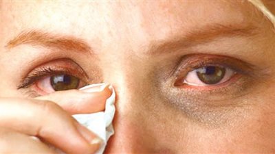 علاج مضاعفات حساسية العين