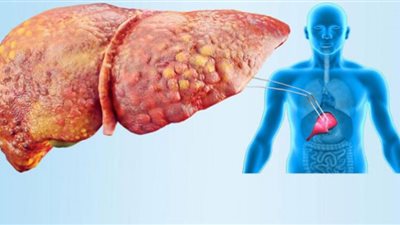مشروبات تقلل من خطر الإصابة بالكبد الدهني