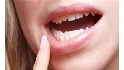علامات تحذيرية لتجنب سرطان الفم