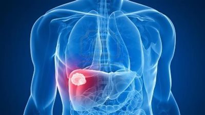 طبيبة تكشف أعراض غير واضحة لتليف الكبد