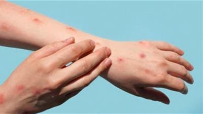 تسجيل ثاني وفاة بجدري القرود في أمريكا
