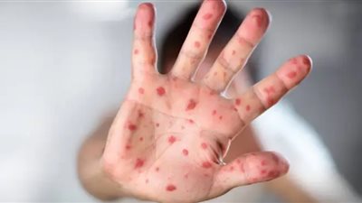 ارتفاع إصابات جدري القرود في التشيك إلى 50 حالة