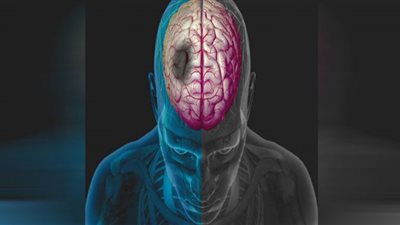 الإجهاد يزيد من خطر الإصابة بالجلطة الدماغية.. احذر