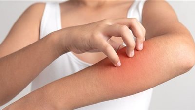 وصفات منزلية مفيدة للتغلب على أعراض الحساسية