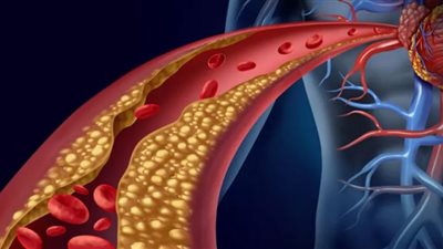 نقص فيتامين B12 يسبب تلف الشرايين