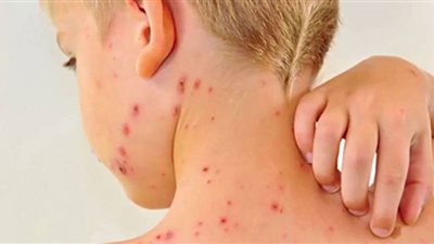 أعراض الحصبة الألمانية بعد انتشارها في السودان