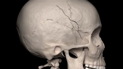 علماء يطورون جهازًا لترميم تشوهات الجمجمة