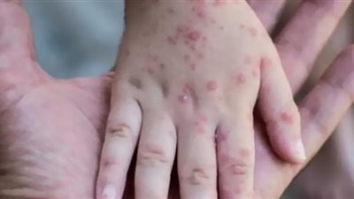 أوكرانيا تسجل أول إصابة بفيروس جدري القرود