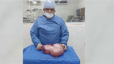 إستئصال ورم ضخم من بطن طفلة بمركز أورام طنطا