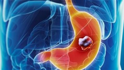 لماذا الرجال أكثر عرضة للإصابة بسرطان المعدة عن النساء؟