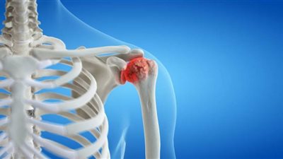 تآكل المفاصل.. الأسباب وطرق العلاج