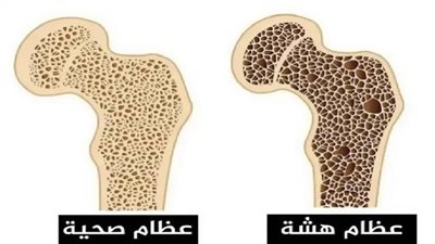 كيفية الوقاية من مرض هشاشة العظام