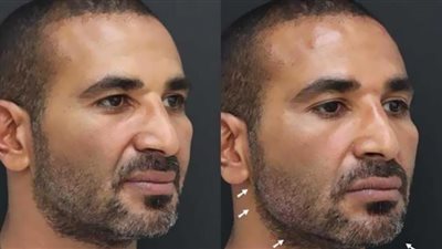 أحمد سعد يثير الجدل.. خضع لعملية تجميل جديدة (صور)