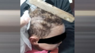 استخراج خشبة ومسمارين من رأس طفل بجامعة الزقازيق |صور