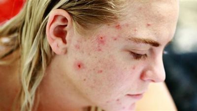 أسباب ظهور حب الشباب وعادات تقلل منها