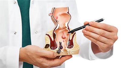 عادات يومية تسبب الإصابة بالبواسير