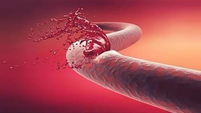 بعد الموافقة على أغلى دواء بالعالم لعلاجه.. ما هو مرض هيموفيليا B وأعراضه؟